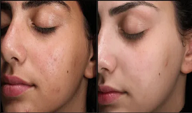 Skin whitening in Islamabad