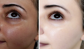 effective Skin whitening in Islamabad