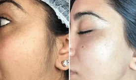 Skin whitening results in Islamabad