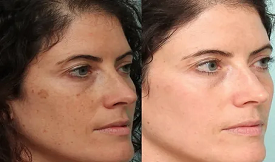 safe Skin whitening in Islamabad