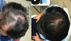 Stem Cell Treatment For Hair Loss in Islamabad