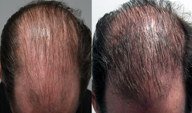 Best Stem Cell Treatment For Hair Loss in Islamabad