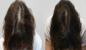 Stem Cell Treatment For Hair Loss results in Islamabad