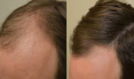 Affordable Stem Cell Treatment For Hair Loss in Islamabad