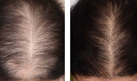 Safe Stem Cell Treatment For Hair Loss in Islamabad