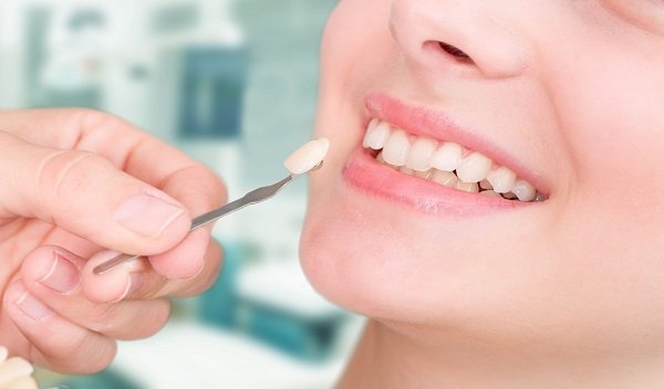 Veneers in Islamabad