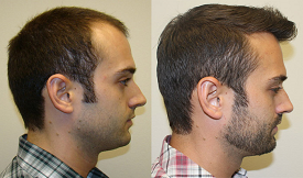 body hair transplant in islamabad