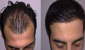 affordable body hair transplant in islamabad
