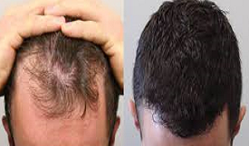best body hair transplant in islamabad