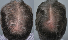 body hair transplant result in islamabad