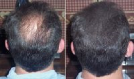effective body hair transplant in islamabad