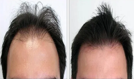 safe body hair transplant in islamabad