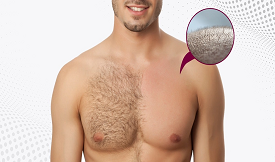 body hair transplant in islamabad