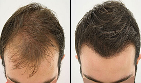 FUE Hair Transplant in Islamabad