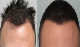 Best FUE Hair Transplant in Islamabad
