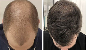 FUE Hair Transplant results in Islamabad