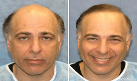 safe FUE Hair Transplant in Islamabad