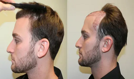 Affordable FUE Hair Transplant in Islamabad