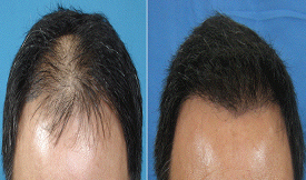 FUE Hair Transplant result in Islamabad