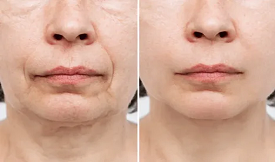 Thread Lift treatment in Islamabad