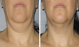 Thread Lift results in Islamabad