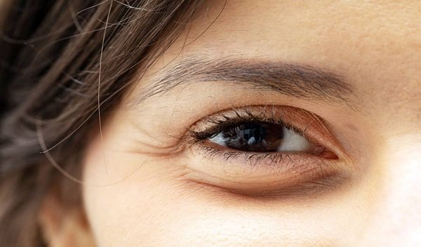 Eye Bag Removal in Islamabad