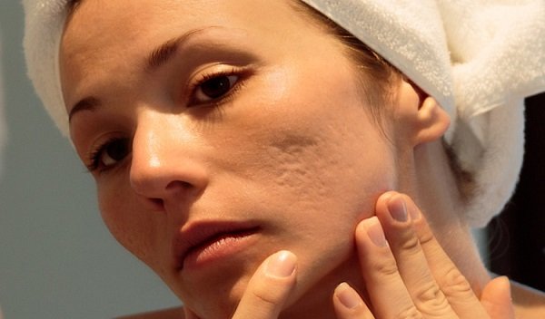 Laser scar removal in Islamabad