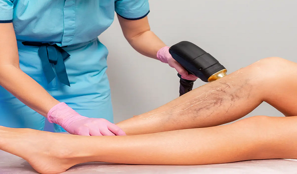 Spider Veins Treatment in Islamabad