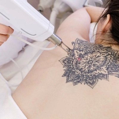 Tattoo Removal Cost in Islamabad