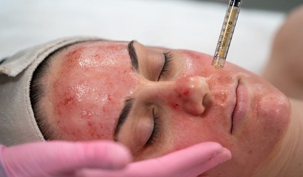 Vampire Facial in Islamabad