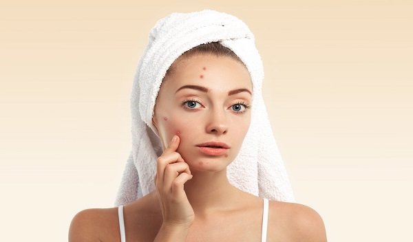 Acne Treatment in Islamabad