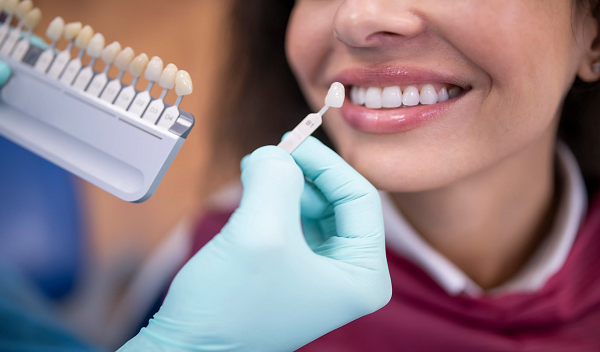 E-Max Veneers in Islamabad