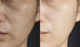 Glutathione Injection Cost in Islamabad