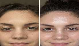 Glutathione Injection before after results