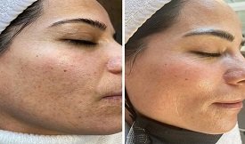Glutathione Injection before after