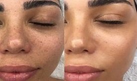 Glutathione Injection in Islamabad