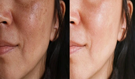 Glutathione Injection