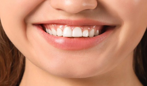 Gummy Smile Treatment in Islamabad