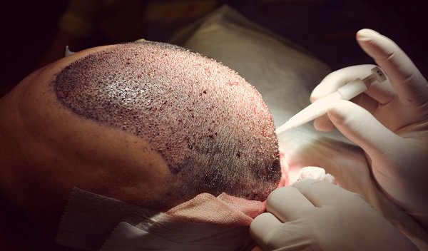 Hair Transplant in Islamabad