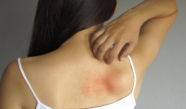 Lipoma Treatment in Islamabad