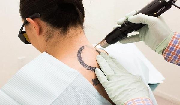 Picosure Tattoo Removal In Islamabad