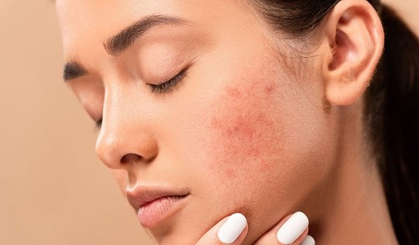 Pimple Treatment in Islamabad