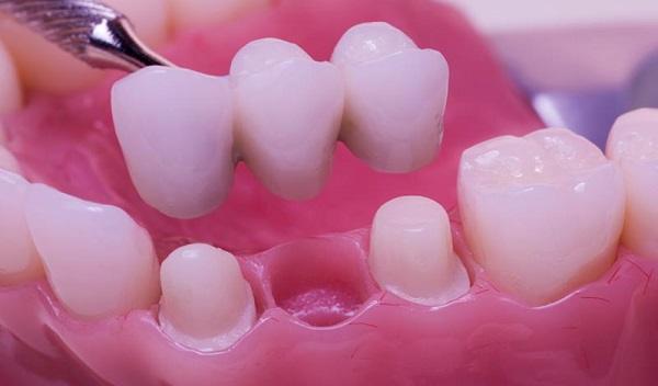 Dental Crowns in Islamabad