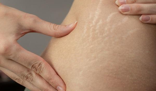 Stretch Mark Removal in Islamabad