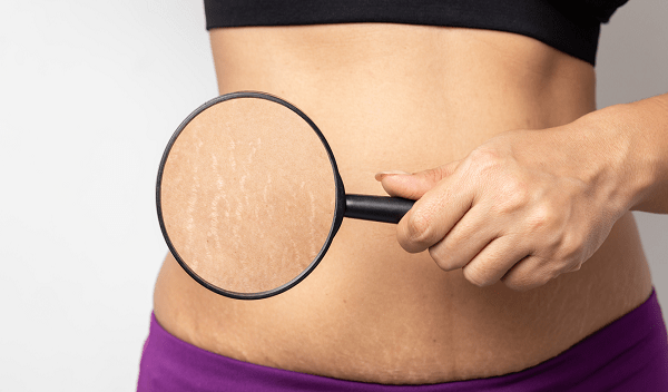 Stretch Mark Removal in Islamabad