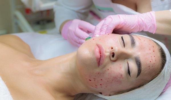 Vampire Facelift in Islamabad