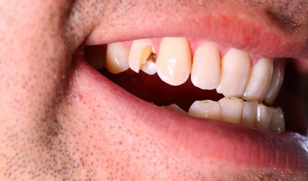 Fractured Tooth in Islamabad