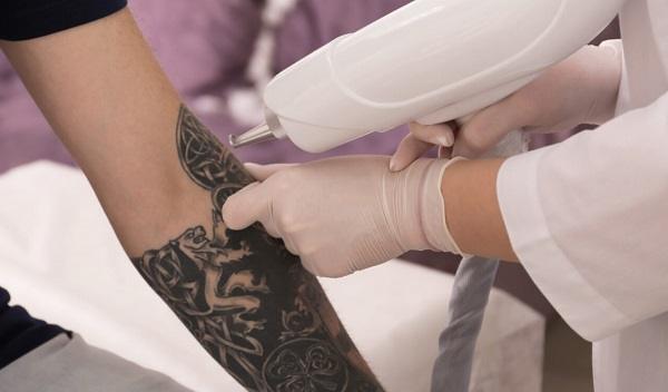 Henna Tattoo Removal in Islamabad